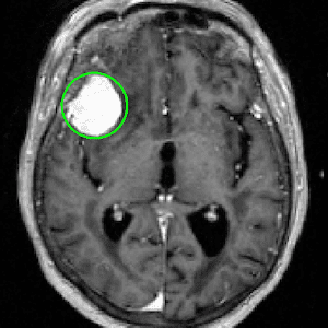 опухоль головного мозга на МРТ